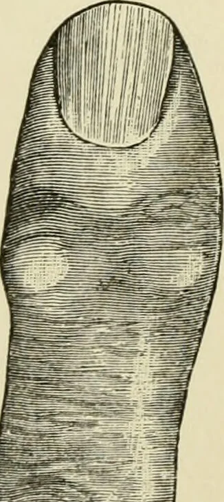 An illustration from Practical diagnosis: the use of symptoms in the diagnosis of disease / By Hobart Amory Hare ... Illustrated with 191 engravings and 13 colored plates., 1896, leaf 50