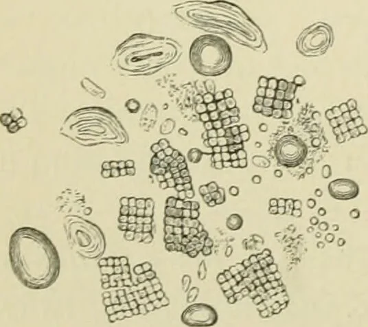 An illustration from Practical diagnosis: the use of symptoms in the diagnosis of disease / By Hobart Amory Hare ... Illustrated with 191 engravings and 13 colored plates., 1896, leaf 514