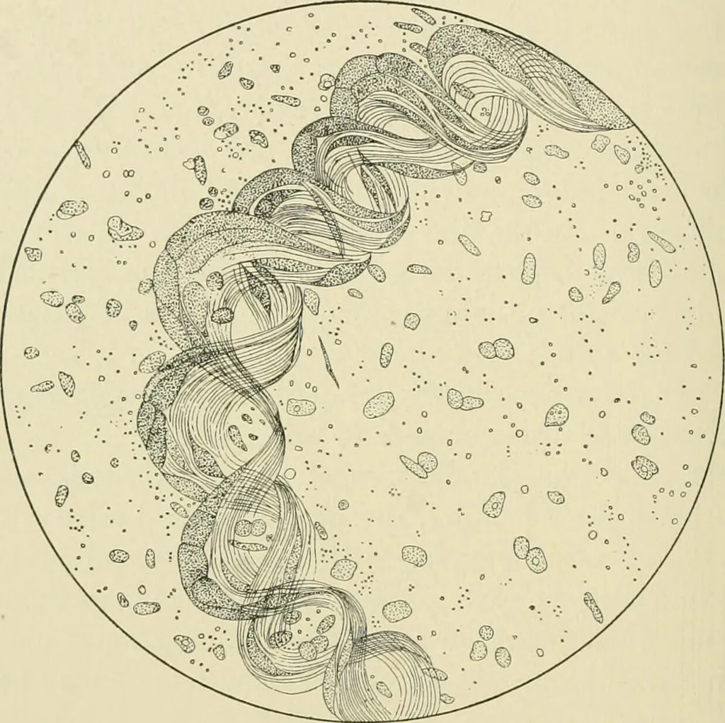 An illustration from Practical diagnosis: the use of symptoms in the diagnosis of disease / By Hobart Amory Hare ... Illustrated with 191 engravings and 13 colored plates., 1896, leaf 526
