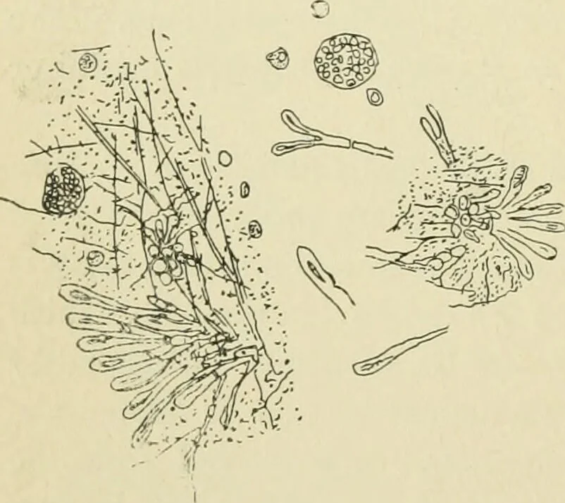 An illustration from Practical diagnosis: the use of symptoms in the diagnosis of disease / By Hobart Amory Hare ... Illustrated with 191 engravings and 13 colored plates., 1896, leaf 528