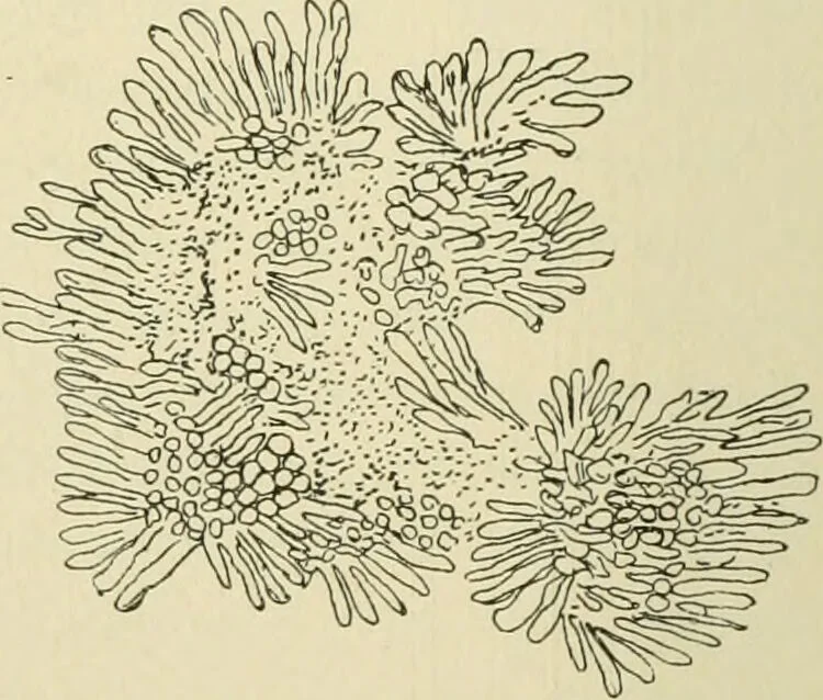 An illustration from Practical diagnosis: the use of symptoms in the diagnosis of disease / By Hobart Amory Hare ... Illustrated with 191 engravings and 13 colored plates., 1896, leaf 528
