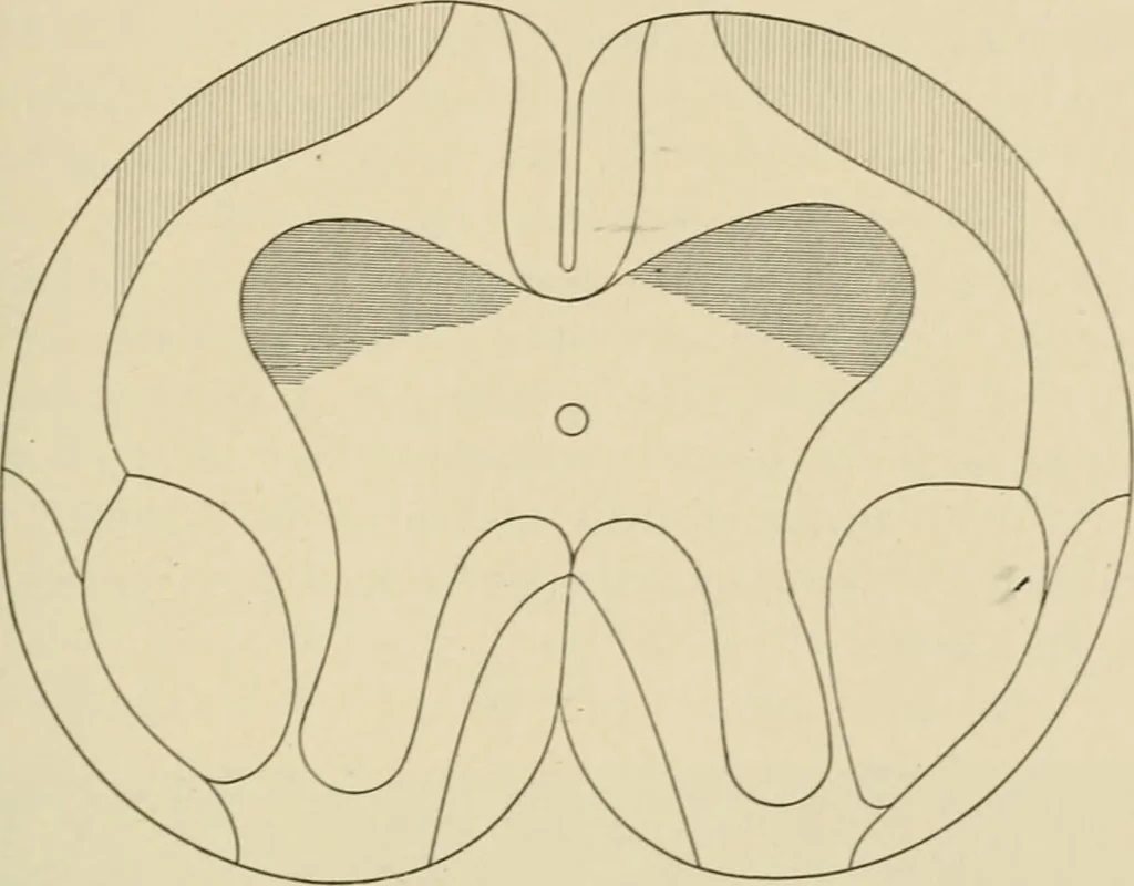 An illustration from Practical diagnosis: the use of symptoms in the diagnosis of disease / By Hobart Amory Hare ... Illustrated with 191 engravings and 13 colored plates., 1896, leaf 57
