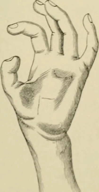 An illustration from Practical diagnosis: the use of symptoms in the diagnosis of disease / By Hobart Amory Hare ... Illustrated with 191 engravings and 13 colored plates., 1896, leaf 57