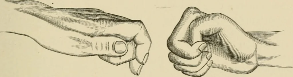 An illustration from Practical diagnosis: the use of symptoms in the diagnosis of disease / By Hobart Amory Hare ... Illustrated with 191 engravings and 13 colored plates., 1896, leaf 61