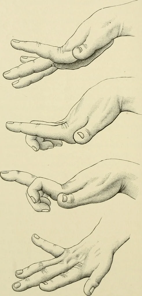 An illustration from Practical diagnosis: the use of symptoms in the diagnosis of disease / By Hobart Amory Hare ... Illustrated with 191 engravings and 13 colored plates., 1896, leaf 68