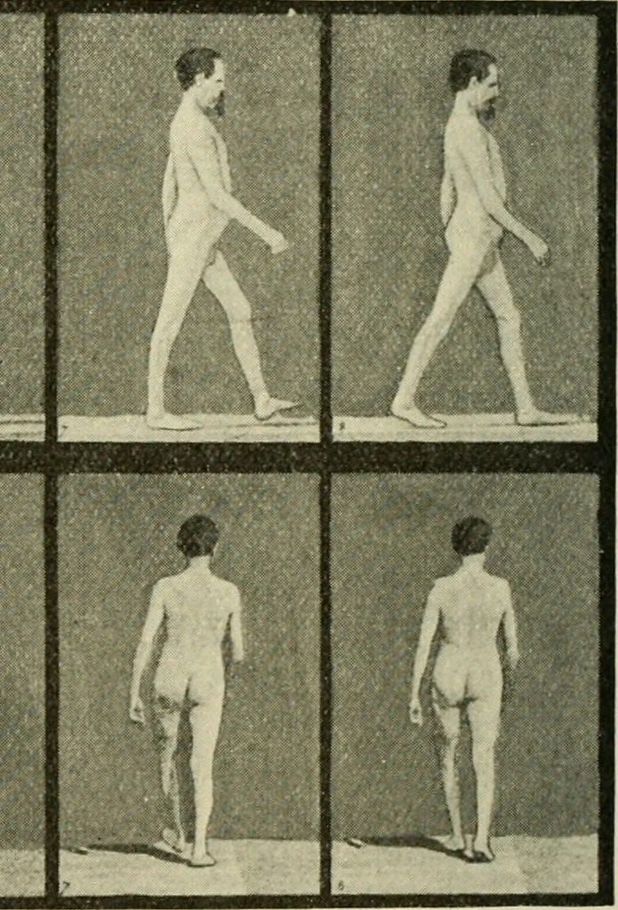 An illustration from Practical diagnosis: the use of symptoms in the diagnosis of disease / By Hobart Amory Hare ... Illustrated with 191 engravings and 13 colored plates., 1896, leaf 76