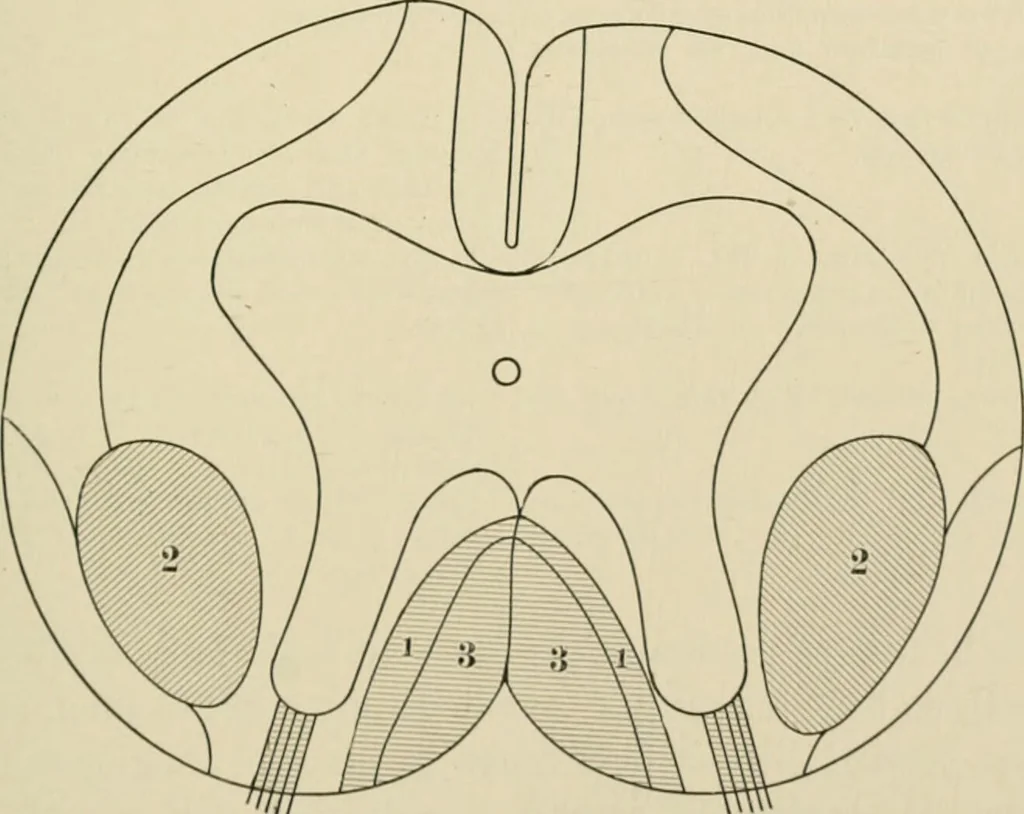 An illustration from Practical diagnosis: the use of symptoms in the diagnosis of disease / By Hobart Amory Hare ... Illustrated with 191 engravings and 13 colored plates., 1896, leaf 79