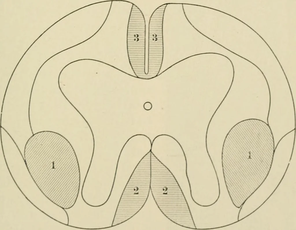 An illustration from Practical diagnosis: the use of symptoms in the diagnosis of disease / By Hobart Amory Hare ... Illustrated with 191 engravings and 13 colored plates., 1896, leaf 81
