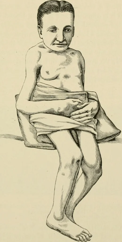 An illustration from Practical diagnosis: the use of symptoms in the diagnosis of disease / By Hobart Amory Hare ... Illustrated with 191 engravings and 13 colored plates., 1896, leaf 85