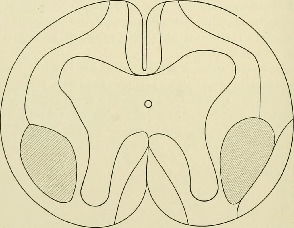 An illustration from Practical diagnosis: the use of symptoms in the diagnosis of disease / By Hobart Amory Hare ... Illustrated with 191 engravings and 13 colored plates., 1896, leaf 88
