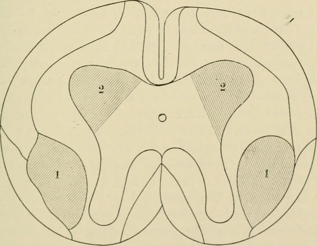 An illustration from Practical diagnosis: the use of symptoms in the diagnosis of disease / By Hobart Amory Hare ... Illustrated with 191 engravings and 13 colored plates., 1896, leaf 89