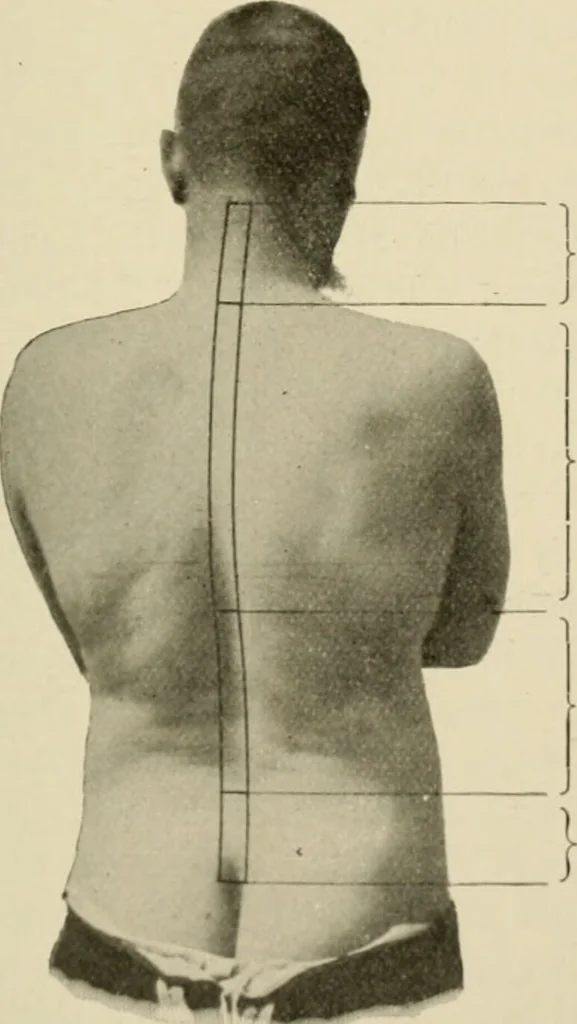 An illustration from Practical diagnosis: the use of symptoms in the diagnosis of disease / By Hobart Amory Hare ... Illustrated with 191 engravings and 13 colored plates., 1896, leaf 97