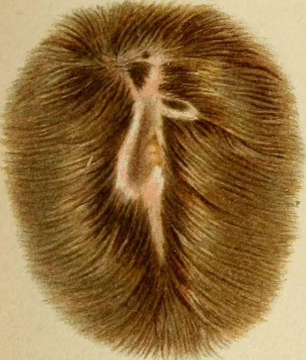 An illustration from Atlas and epitome of diseases caused by accidents / by Dr. Ed. Golebiewski ... authorized translation from the German, with editorial notes and additions by Pearce Bailey ... 40 colored plates, and 143 illustrations in black., 1900, leaf 105