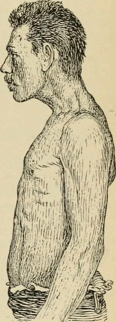 An illustration from Atlas and epitome of diseases caused by accidents / by Dr. Ed. Golebiewski ... authorized translation from the German, with editorial notes and additions by Pearce Bailey ... 40 colored plates, and 143 illustrations in black., 1900, leaf 177