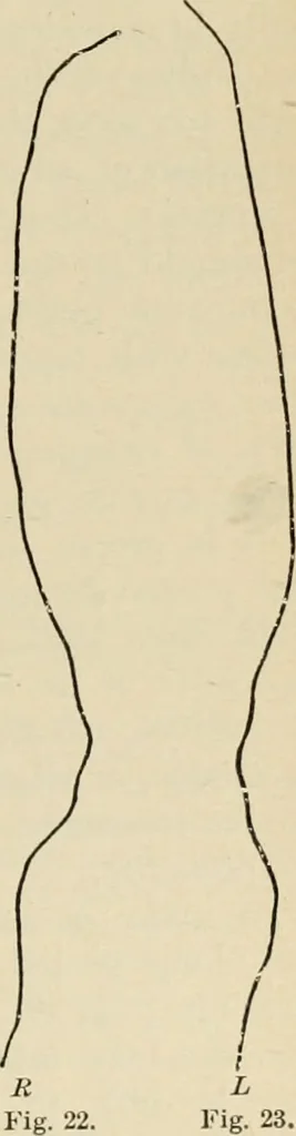 An illustration from Atlas and epitome of diseases caused by accidents / by Dr. Ed. Golebiewski ... authorized translation from the German, with editorial notes and additions by Pearce Bailey ... 40 colored plates, and 143 illustrations in black., 1900, leaf 191