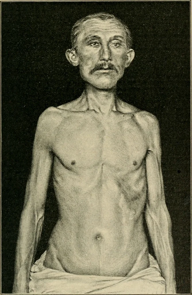 An illustration from Atlas and epitome of diseases caused by accidents / by Dr. Ed. Golebiewski ... authorized translation from the German, with editorial notes and additions by Pearce Bailey ... 40 colored plates, and 143 illustrations in black., 1900, leaf 217