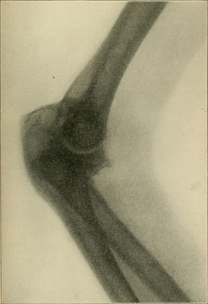 An illustration from Atlas and epitome of diseases caused by accidents / by Dr. Ed. Golebiewski ... authorized translation from the German, with editorial notes and additions by Pearce Bailey ... 40 colored plates, and 143 illustrations in black., 1900, leaf 331