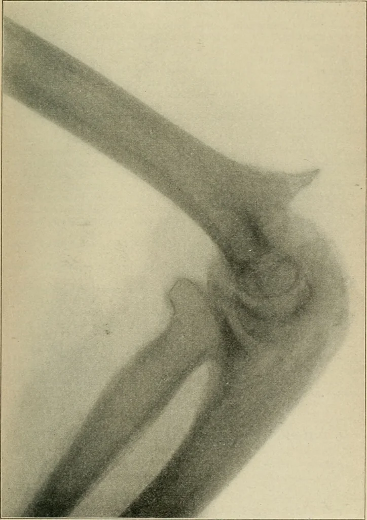 An illustration from Atlas and epitome of diseases caused by accidents / by Dr. Ed. Golebiewski ... authorized translation from the German, with editorial notes and additions by Pearce Bailey ... 40 colored plates, and 143 illustrations in black., 1900, leaf 333