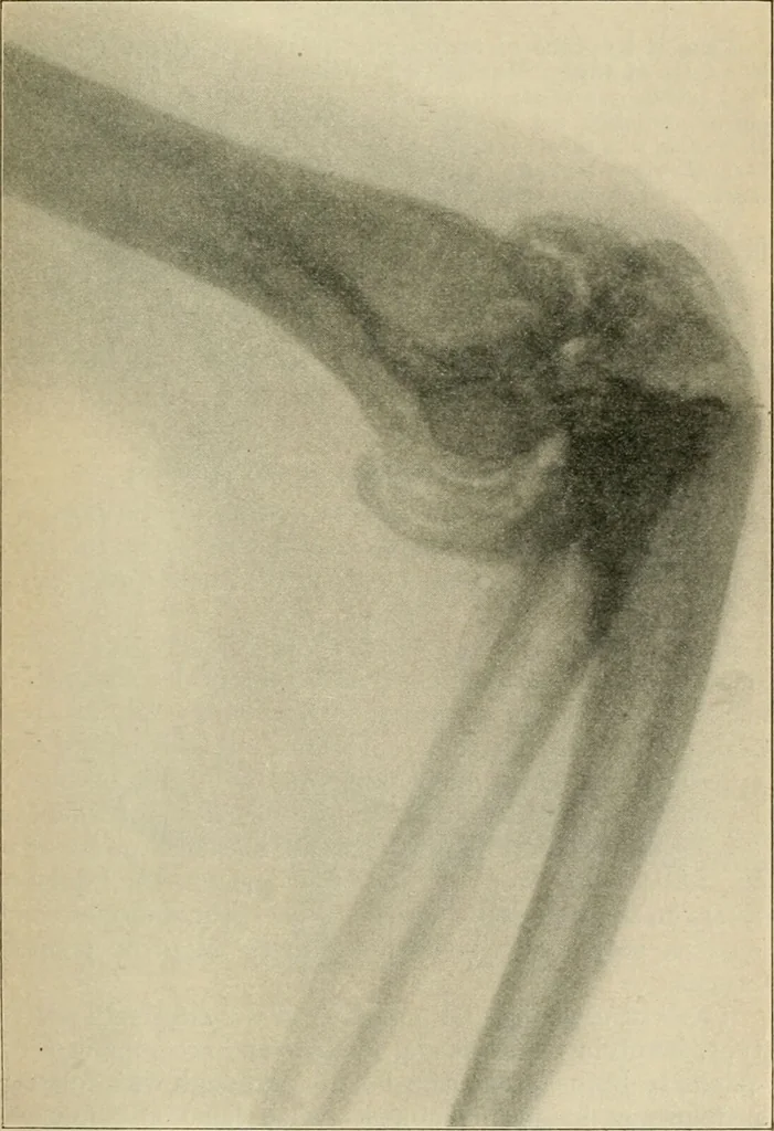 An illustration from Atlas and epitome of diseases caused by accidents / by Dr. Ed. Golebiewski ... authorized translation from the German, with editorial notes and additions by Pearce Bailey ... 40 colored plates, and 143 illustrations in black., 1900, leaf 335