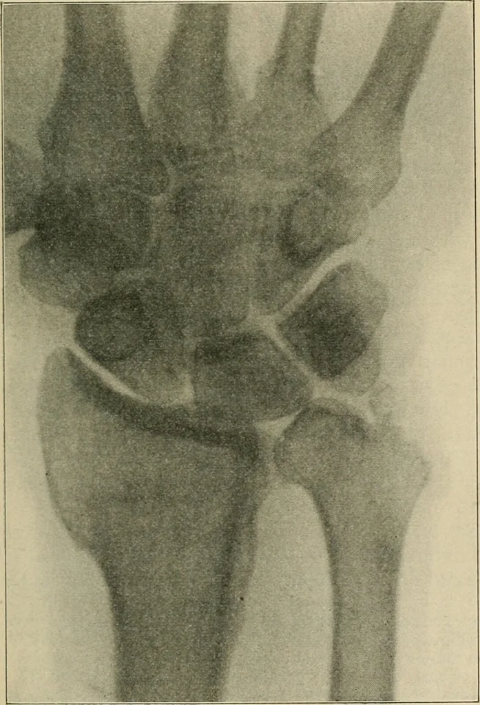 An illustration from Atlas and epitome of diseases caused by accidents / by Dr. Ed. Golebiewski ... authorized translation from the German, with editorial notes and additions by Pearce Bailey ... 40 colored plates, and 143 illustrations in black., 1900, leaf 349