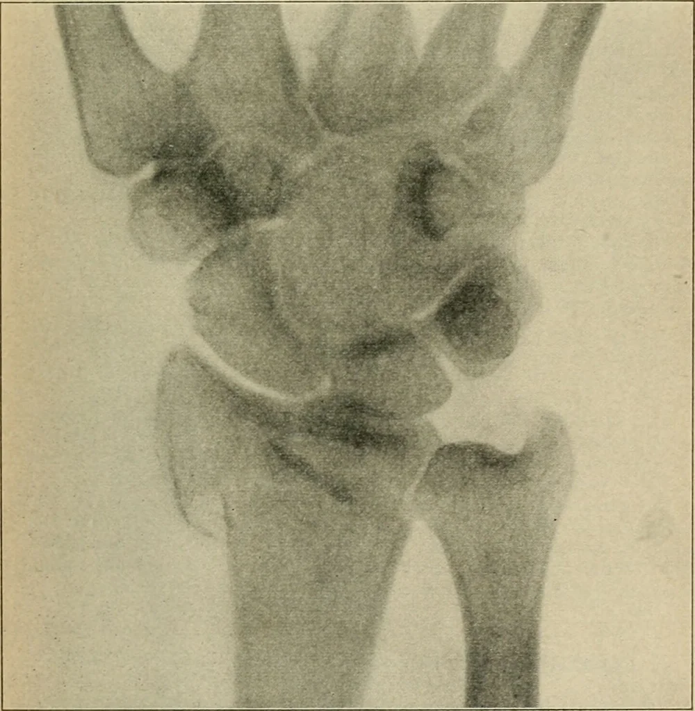 An illustration from Atlas and epitome of diseases caused by accidents / by Dr. Ed. Golebiewski ... authorized translation from the German, with editorial notes and additions by Pearce Bailey ... 40 colored plates, and 143 illustrations in black., 1900, leaf 351