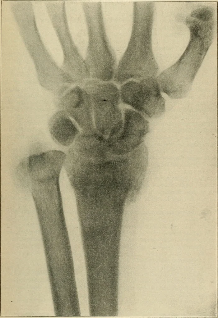 An illustration from Atlas and epitome of diseases caused by accidents / by Dr. Ed. Golebiewski ... authorized translation from the German, with editorial notes and additions by Pearce Bailey ... 40 colored plates, and 143 illustrations in black., 1900, leaf 353