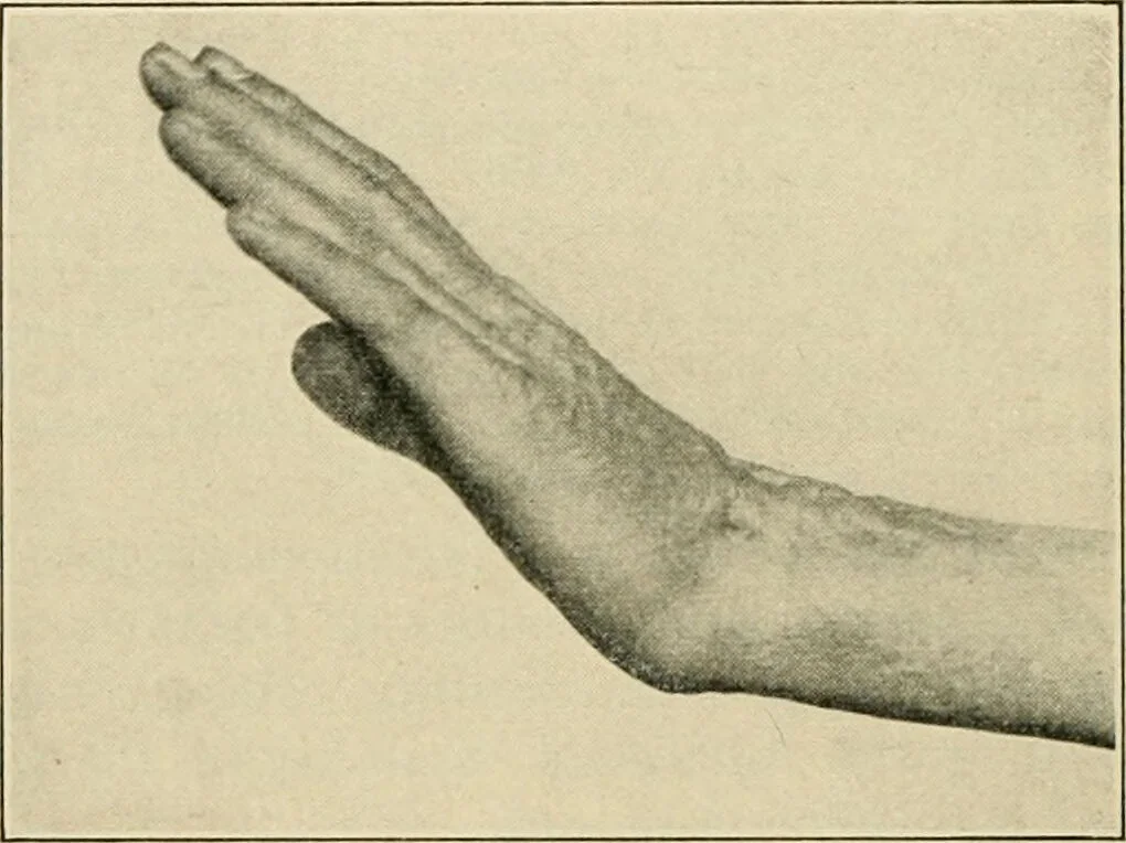 An illustration from Atlas and epitome of diseases caused by accidents / by Dr. Ed. Golebiewski ... authorized translation from the German, with editorial notes and additions by Pearce Bailey ... 40 colored plates, and 143 illustrations in black., 1900, leaf 366