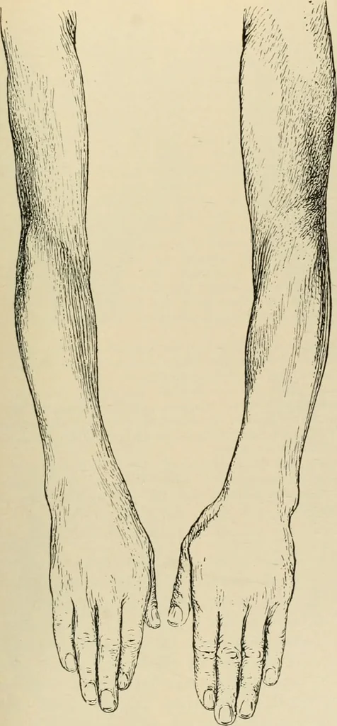 An illustration from Atlas and epitome of diseases caused by accidents / by Dr. Ed. Golebiewski ... authorized translation from the German, with editorial notes and additions by Pearce Bailey ... 40 colored plates, and 143 illustrations in black., 1900, leaf 387