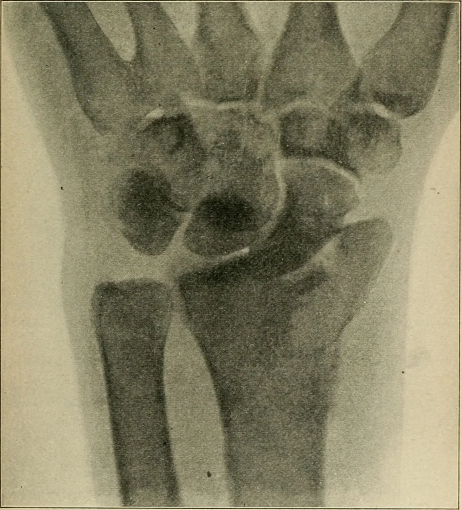An illustration from Atlas and epitome of diseases caused by accidents / by Dr. Ed. Golebiewski ... authorized translation from the German, with editorial notes and additions by Pearce Bailey ... 40 colored plates, and 143 illustrations in black., 1900, leaf 391