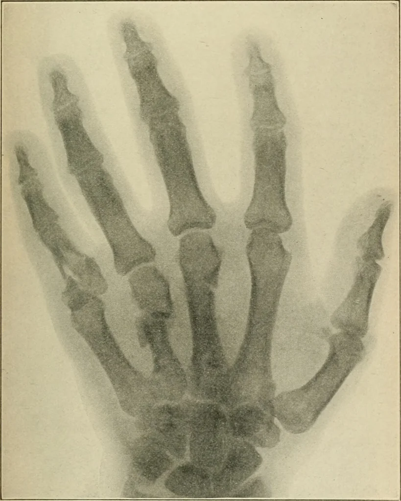 An illustration from Atlas and epitome of diseases caused by accidents / by Dr. Ed. Golebiewski ... authorized translation from the German, with editorial notes and additions by Pearce Bailey ... 40 colored plates, and 143 illustrations in black., 1900, leaf 393
