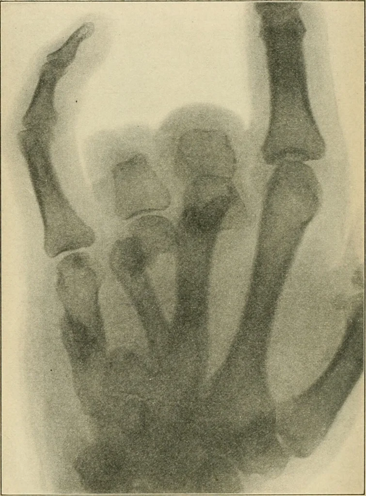 An illustration from Atlas and epitome of diseases caused by accidents / by Dr. Ed. Golebiewski ... authorized translation from the German, with editorial notes and additions by Pearce Bailey ... 40 colored plates, and 143 illustrations in black., 1900, leaf 394
