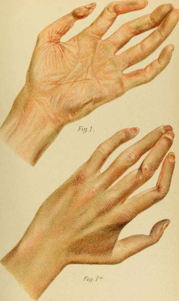 An illustration from Atlas and epitome of diseases caused by accidents / by Dr. Ed. Golebiewski ... authorized translation from the German, with editorial notes and additions by Pearce Bailey ... 40 colored plates, and 143 illustrations in black., 1900, leaf 401