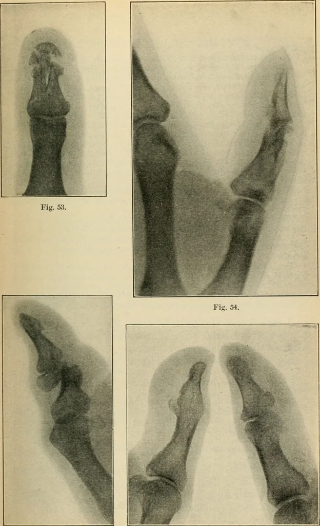 An illustration from Atlas and epitome of diseases caused by accidents / by Dr. Ed. Golebiewski ... authorized translation from the German, with editorial notes and additions by Pearce Bailey ... 40 colored plates, and 143 illustrations in black., 1900, leaf 411