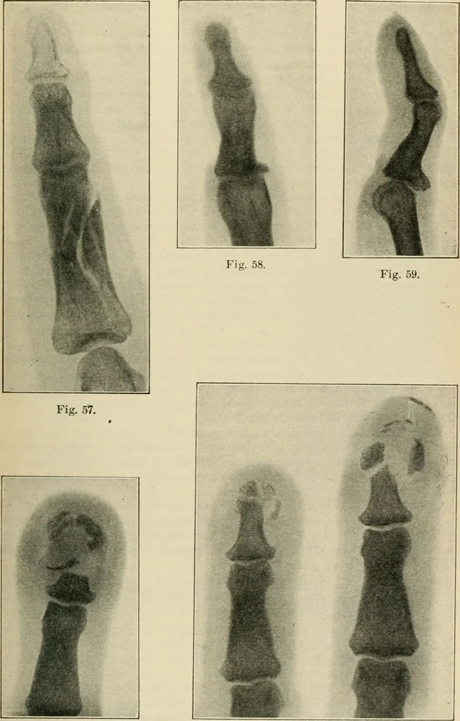 An illustration from Atlas and epitome of diseases caused by accidents / by Dr. Ed. Golebiewski ... authorized translation from the German, with editorial notes and additions by Pearce Bailey ... 40 colored plates, and 143 illustrations in black., 1900, leaf 415