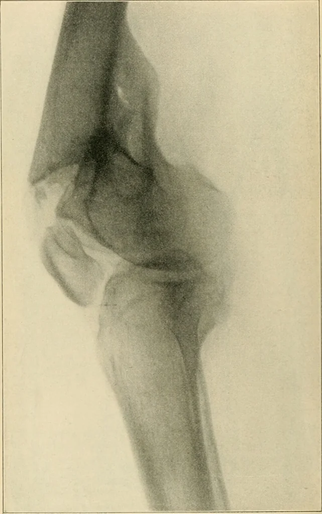 An illustration from Atlas and epitome of diseases caused by accidents / by Dr. Ed. Golebiewski ... authorized translation from the German, with editorial notes and additions by Pearce Bailey ... 40 colored plates, and 143 illustrations in black., 1900, leaf 460