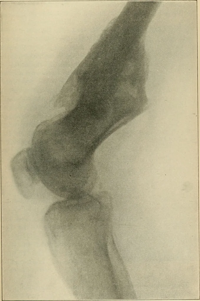 An illustration from Atlas and epitome of diseases caused by accidents / by Dr. Ed. Golebiewski ... authorized translation from the German, with editorial notes and additions by Pearce Bailey ... 40 colored plates, and 143 illustrations in black., 1900, leaf 461