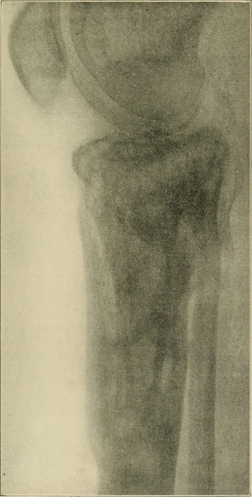 An illustration from Atlas and epitome of diseases caused by accidents / by Dr. Ed. Golebiewski ... authorized translation from the German, with editorial notes and additions by Pearce Bailey ... 40 colored plates, and 143 illustrations in black., 1900, leaf 493