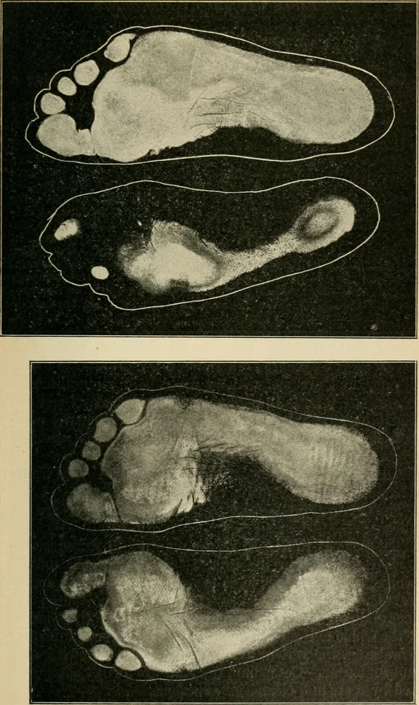 An illustration from Atlas and epitome of diseases caused by accidents / by Dr. Ed. Golebiewski ... authorized translation from the German, with editorial notes and additions by Pearce Bailey ... 40 colored plates, and 143 illustrations in black., 1900, leaf 501
