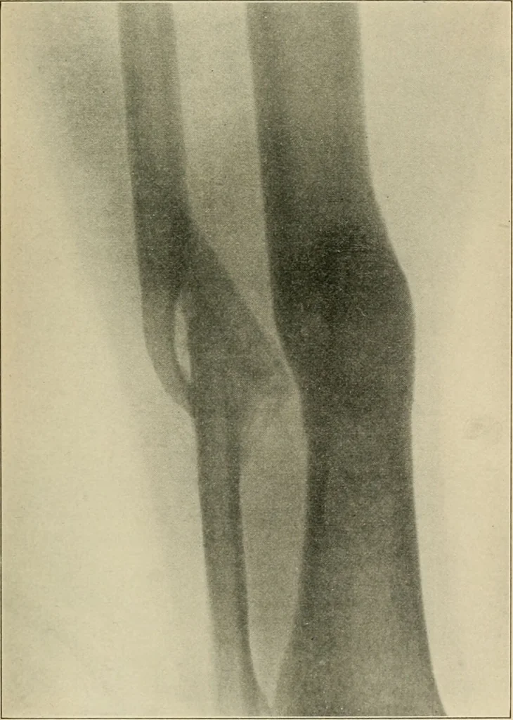 An illustration from Atlas and epitome of diseases caused by accidents / by Dr. Ed. Golebiewski ... authorized translation from the German, with editorial notes and additions by Pearce Bailey ... 40 colored plates, and 143 illustrations in black., 1900, leaf 507