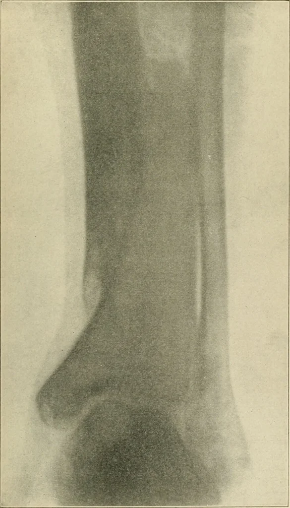 An illustration from Atlas and epitome of diseases caused by accidents / by Dr. Ed. Golebiewski ... authorized translation from the German, with editorial notes and additions by Pearce Bailey ... 40 colored plates, and 143 illustrations in black., 1900, leaf 517