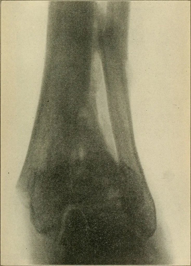 An illustration from Atlas and epitome of diseases caused by accidents / by Dr. Ed. Golebiewski ... authorized translation from the German, with editorial notes and additions by Pearce Bailey ... 40 colored plates, and 143 illustrations in black., 1900, leaf 523