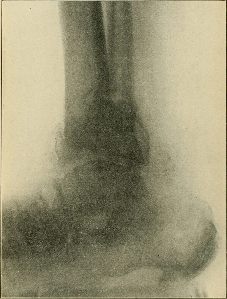 An illustration from Atlas and epitome of diseases caused by accidents / by Dr. Ed. Golebiewski ... authorized translation from the German, with editorial notes and additions by Pearce Bailey ... 40 colored plates, and 143 illustrations in black., 1900, leaf 524