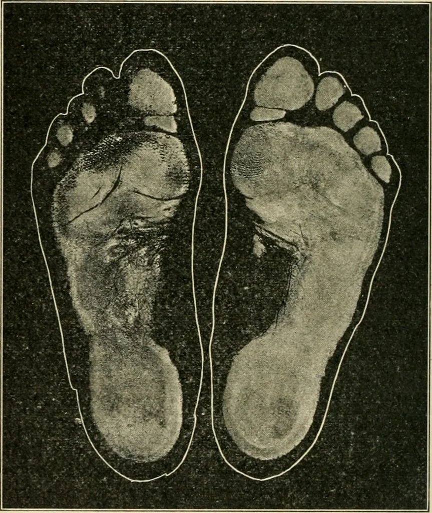An illustration from Atlas and epitome of diseases caused by accidents / by Dr. Ed. Golebiewski ... authorized translation from the German, with editorial notes and additions by Pearce Bailey ... 40 colored plates, and 143 illustrations in black., 1900, leaf 540
