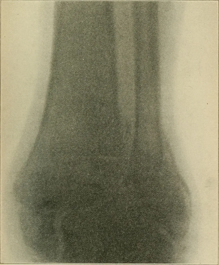 An illustration from Atlas and epitome of diseases caused by accidents / by Dr. Ed. Golebiewski ... authorized translation from the German, with editorial notes and additions by Pearce Bailey ... 40 colored plates, and 143 illustrations in black., 1900, leaf 545