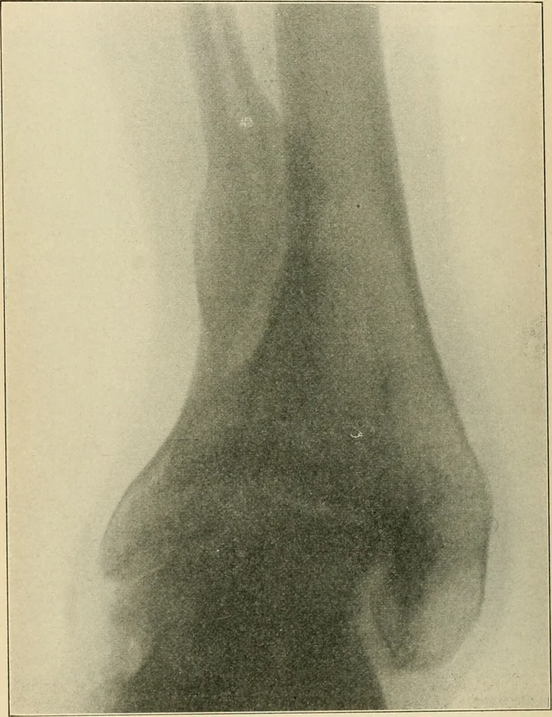 An illustration from Atlas and epitome of diseases caused by accidents / by Dr. Ed. Golebiewski ... authorized translation from the German, with editorial notes and additions by Pearce Bailey ... 40 colored plates, and 143 illustrations in black., 1900, leaf 546