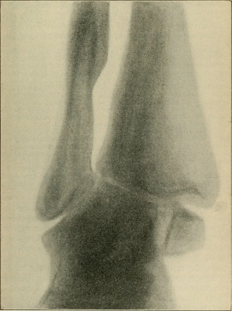 An illustration from Atlas and epitome of diseases caused by accidents / by Dr. Ed. Golebiewski ... authorized translation from the German, with editorial notes and additions by Pearce Bailey ... 40 colored plates, and 143 illustrations in black., 1900, leaf 547