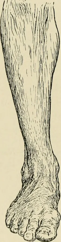 An illustration from Atlas and epitome of diseases caused by accidents / by Dr. Ed. Golebiewski ... authorized translation from the German, with editorial notes and additions by Pearce Bailey ... 40 colored plates, and 143 illustrations in black., 1900, leaf 560