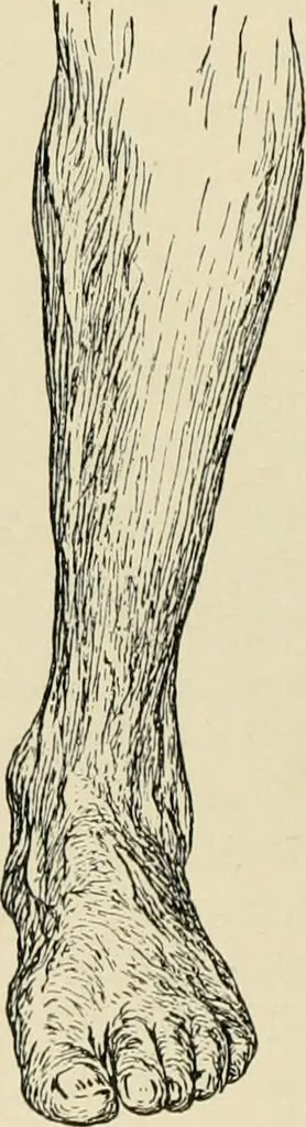 An illustration from Atlas and epitome of diseases caused by accidents / by Dr. Ed. Golebiewski ... authorized translation from the German, with editorial notes and additions by Pearce Bailey ... 40 colored plates, and 143 illustrations in black., 1900, leaf 560
