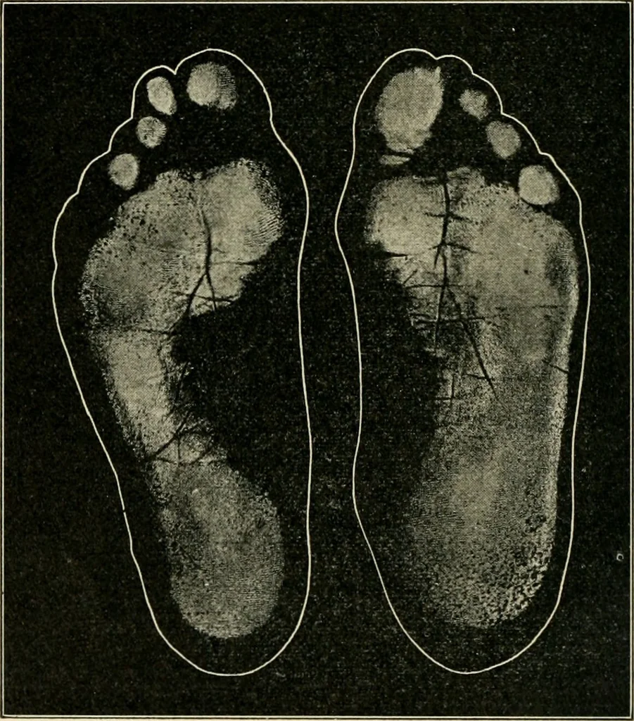 An illustration from Atlas and epitome of diseases caused by accidents / by Dr. Ed. Golebiewski ... authorized translation from the German, with editorial notes and additions by Pearce Bailey ... 40 colored plates, and 143 illustrations in black., 1900, leaf 566
