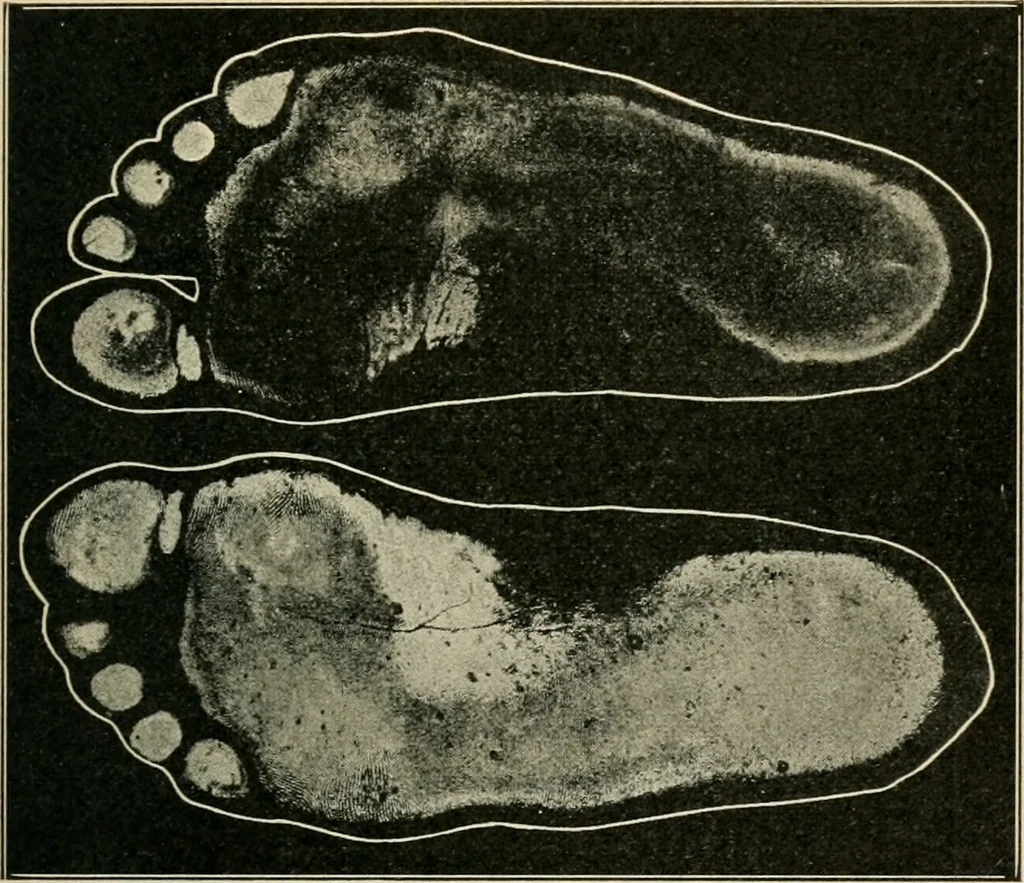 An illustration from Atlas and epitome of diseases caused by accidents / by Dr. Ed. Golebiewski ... authorized translation from the German, with editorial notes and additions by Pearce Bailey ... 40 colored plates, and 143 illustrations in black., 1900, leaf 573